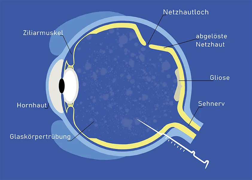 Infografik zur Netzhaut Operation mit Darstellung eines Auges auf dunkelblauem Hintergrund